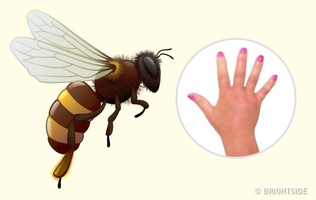Nhận dạng vết cắn côn trùng nhanh chóng và cách giải quyết