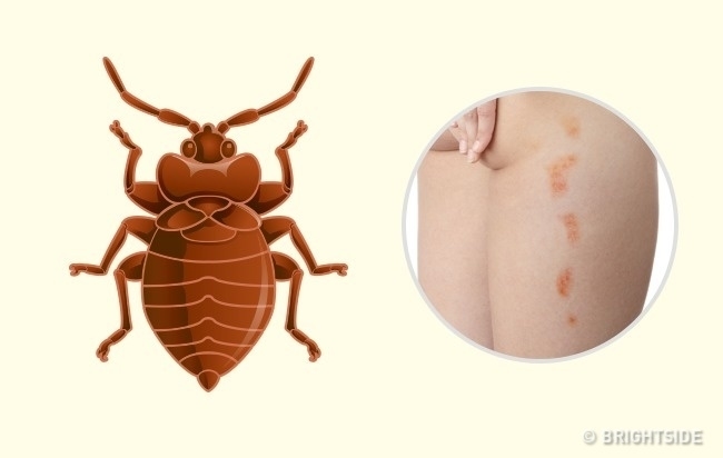 Nhận dạng vết cắn côn trùng nhanh chóng và cách giải quyết