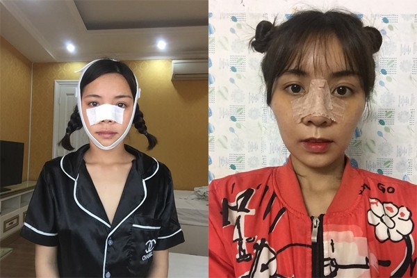 Hậu dao kéo, những cô gái từng bị chê xấu xí bậy giờ ra sao?