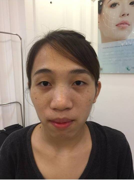 Hậu dao kéo, những cô gái từng bị chê xấu xí bậy giờ ra sao?