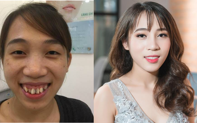 Hậu dao kéo, những cô gái từng bị chê xấu xí bậy giờ ra sao?