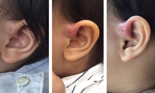Lỗ rò luân nhĩ - khiếm khuyết bẩm sinh rất nguy hiểm của trẻ