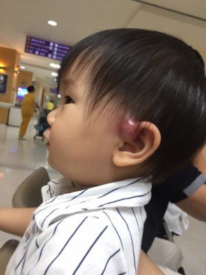 Lỗ rò luân nhĩ - khiếm khuyết bẩm sinh rất nguy hiểm của trẻ