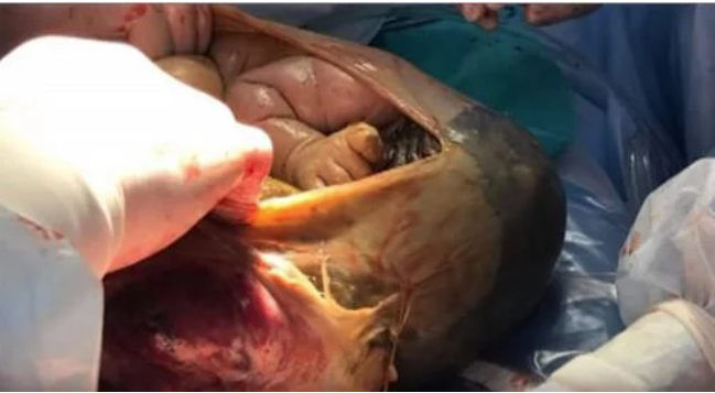 Mang thai suốt 41 tuần không đi siêu âm và sự thật bất ngờ lúc đẻ