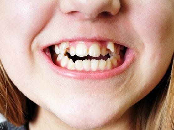 Nhìn tướng răng cũng có thể đoán biết chính xác vận mệnh giàu nghèo!