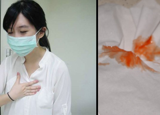 Những dấu hiệu cảnh sớm báo ung thư phổi mà ai cũng không nên bỏ qua