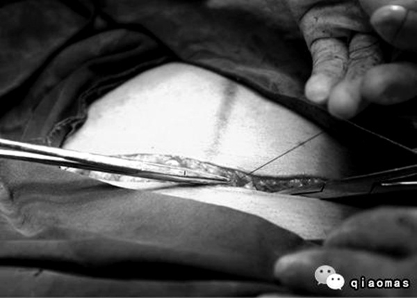 Nỗi khổ của phụ nữ khi phải trải qua ca sinh mổ