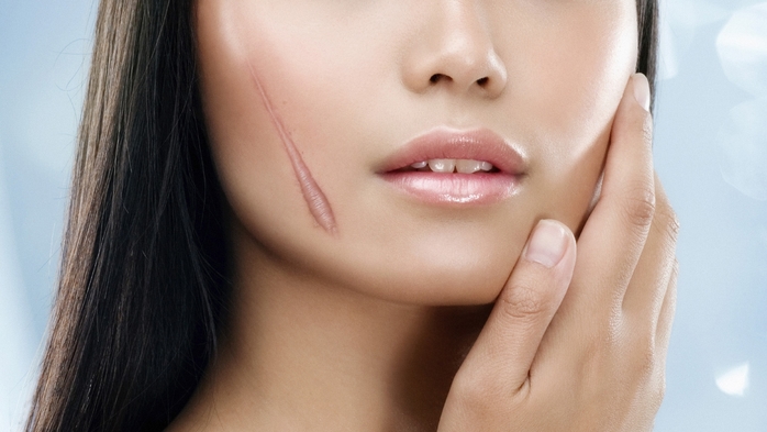 Trị sẹo lồi lâu năm khó chữa với nguyên liệu tự nhiên, rẻ tiền