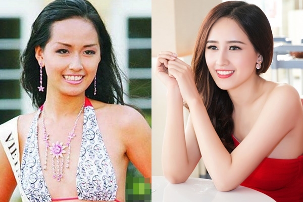 Ngỡ ngàng trước nhan sắc của mỹ nhân Việt trước và sau khi chỉnh răng