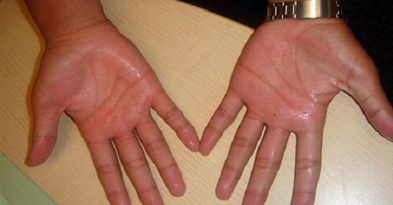 Nhìn tay đoán bệnh nhờ 5 dấu hiệu cảnh báo dễ nhận thấy nhất