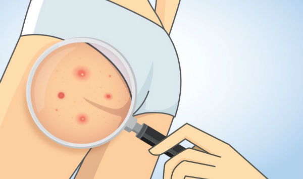 Những cách phòng tránh và trị mụn vòng 3 đơn giản
