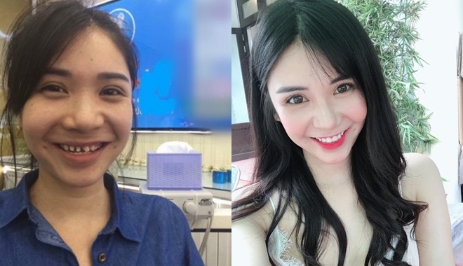 Ngỡ ngàng trước nhan sắc của mỹ nhân Việt trước và sau khi chỉnh răng