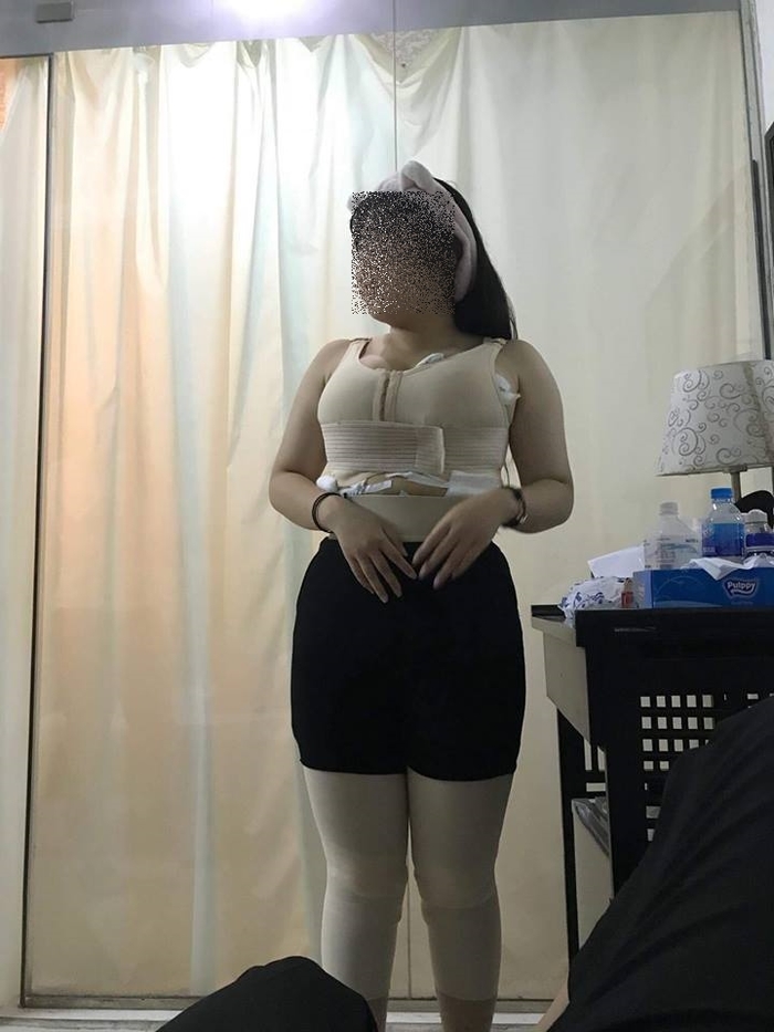 Rùng mình về sự thật những chai mỡ thừa sau khi rút khỏi cơ thể người