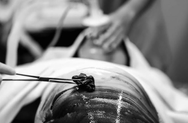 Đừng trách sinh mổ là không biết đẻ, nhìn hình ảnh này mới xót đau