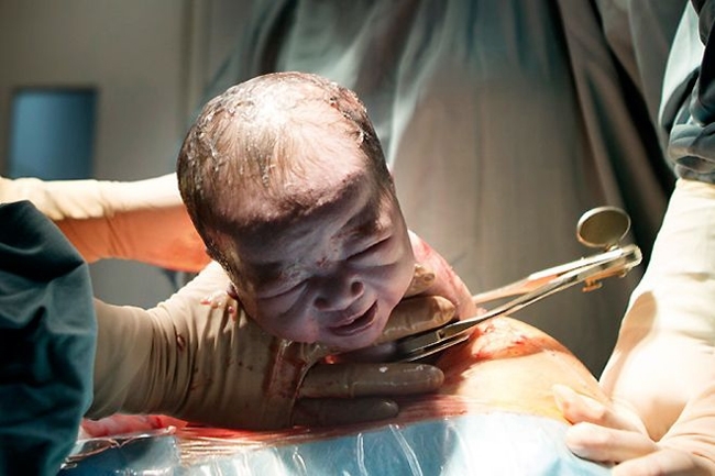 Đừng trách sinh mổ là không biết đẻ, nhìn hình ảnh này mới xót đau