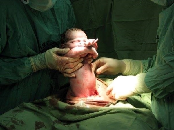Đừng trách sinh mổ là không biết đẻ, nhìn hình ảnh này mới xót đau