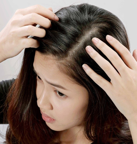 17 thói quen hàng ngày rất dễ gây mụn mà nàng nào cũng mắc phải