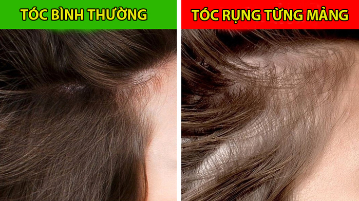 8 dấu hiệu cảnh báo sức khỏe đang có vấn đề thông qua mái tóc