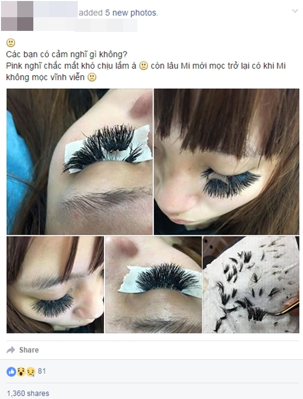 Nối mi làm đẹp, cô gái bị rụng hết lông mi, đôi mắt trụi nhẵn đáng sợ