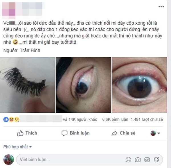 Nối mi làm đẹp, cô gái bị rụng hết lông mi, đôi mắt trụi nhẵn đáng sợ