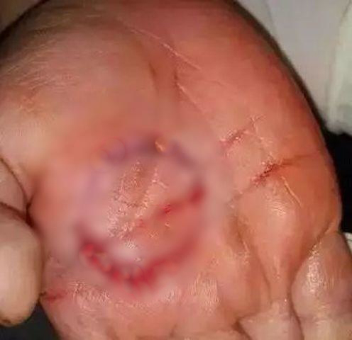 Cô gái bị đứt gân tay chỉ vì chủ quan với bộ phận này trên cây lau nhà