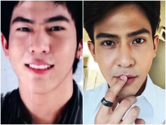 Điểm danh những nam thần dũng cảm thừa nhận “đẹp nhờ dao kéo” của Tbiz