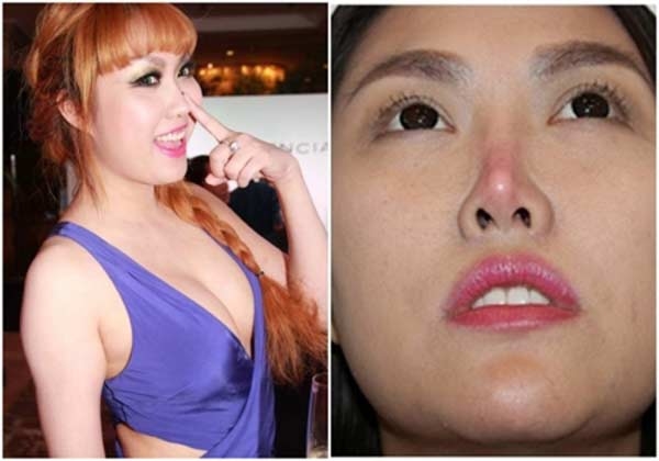 Khi sao Viet lam dep bang silicon: Nguoi no nguc don, ke hoai tu mui