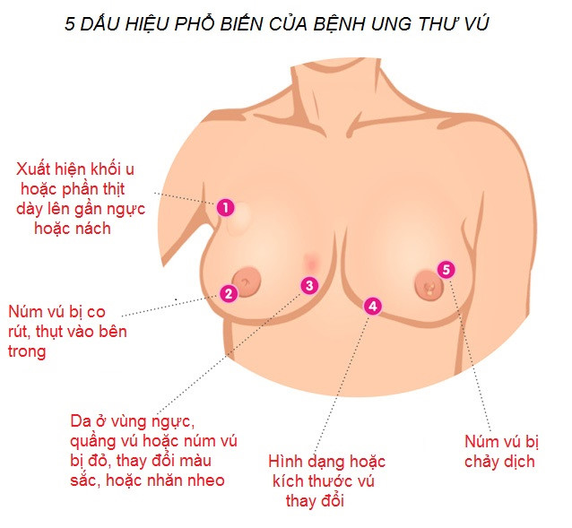 Những dấu hiệu bệnh ung thư sớm chị em cần lưu ý