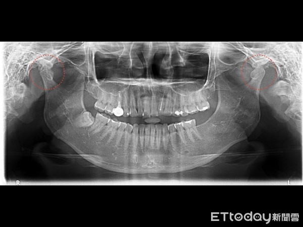 Uống trà sữa trân châu, cô gái bị viêm khớp thái dương hàm