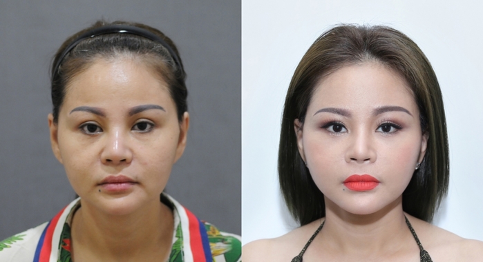 Choáng với những kỷ lục “dao kéo” của sao nữ Vbiz
