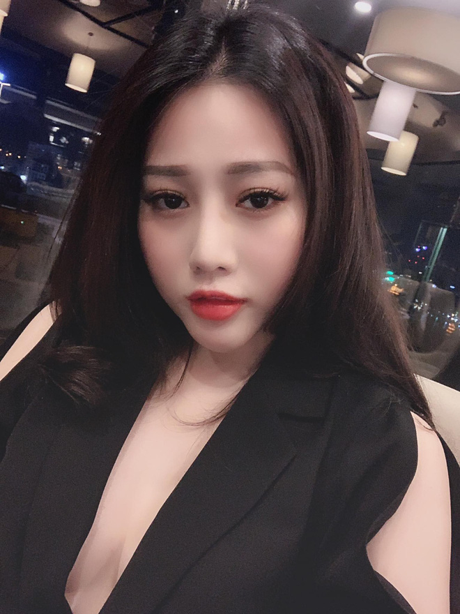 Cô gái trẻ phải tháo độn cằm vì biến chứng do tiêm chất làm đầy