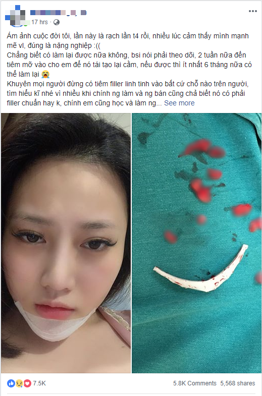 Cô gái trẻ phải tháo độn cằm vì biến chứng do tiêm chất làm đầy
