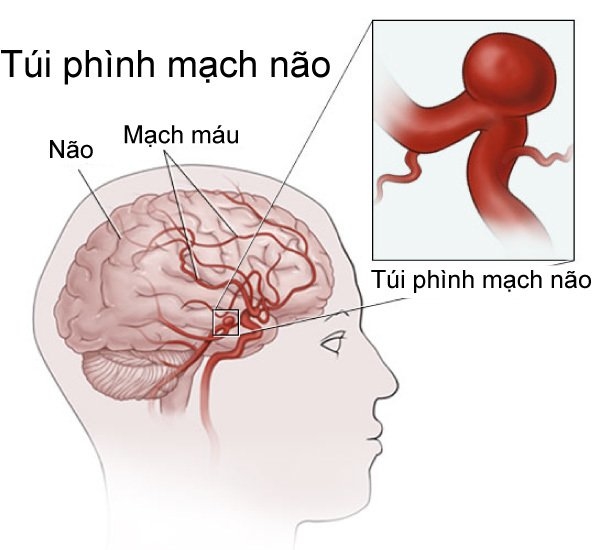 Người phụ nữ đột nhiên đau đầu suýt tử vong vì căn bệnh nguy hiểm