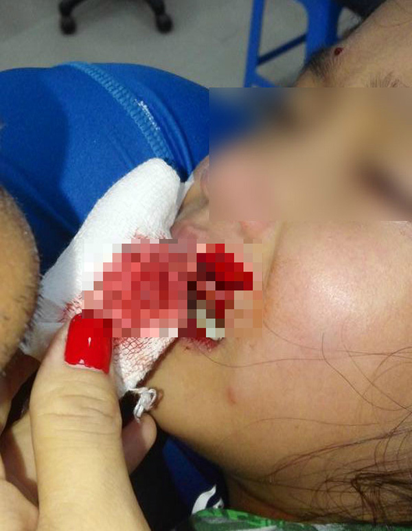 Tre bi cho tan cong 1 Đừng bỏ chạy, la hét, đây là cách thoát thân khi bị chó dữ tấn công