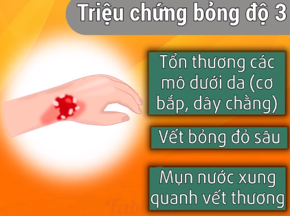 Những cách xử lí kịp thời khi bé bị bỏng mà ba mẹ cần khắc cốt ghi tâm Những cách xử lí kịp thời khi bé bị bỏng mà ba mẹ cần khắc cốt ghi tâm