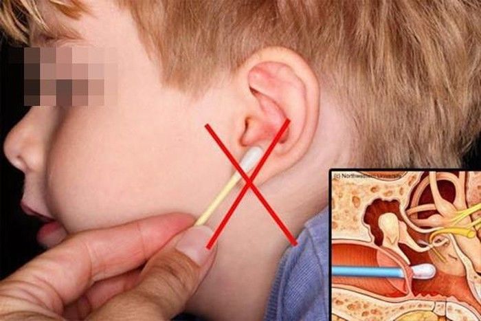 Dùng tăm bông lấy ráy tai, người phụ nữ suýt tử vong vì nhiễm trùng