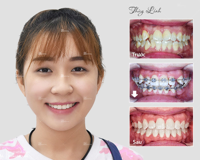 Kinh nghiệm niềng răng để xinh đẹp và khỏe mạnh