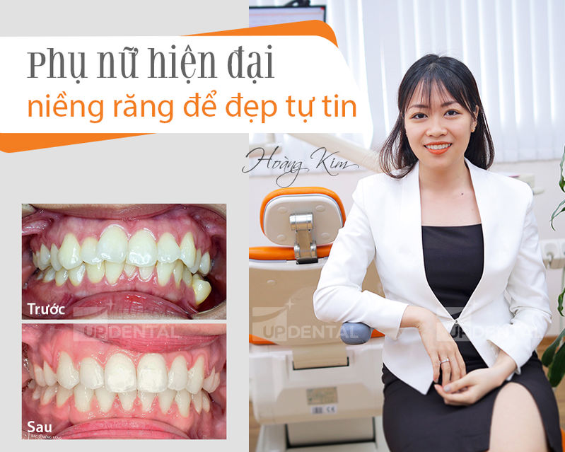 Kinh nghiệm niềng răng để xinh đẹp và khỏe mạnh