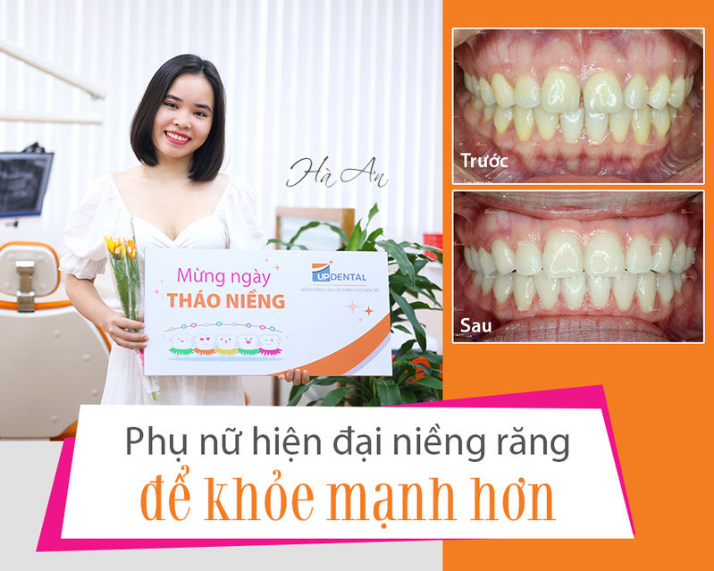Kinh nghiệm niềng răng để xinh đẹp và khỏe mạnh