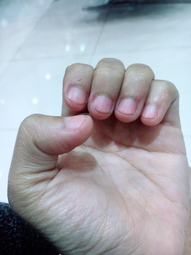 Có một kiểu người móng tay chẳng bao giờ nhú lên được vì cứ rảnh là ngồi cắn - Ảnh 5. Có một kiểu người móng tay chẳng bao giờ nhú lên được vì cứ rảnh là ngồi cắn - Ảnh 5.