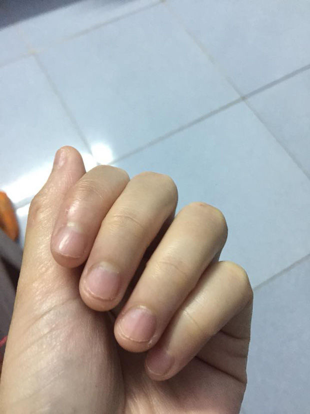 Có một kiểu người móng tay chẳng bao giờ nhú lên được vì cứ rảnh là ngồi cắn - Ảnh 9. Có một kiểu người móng tay chẳng bao giờ nhú lên được vì cứ rảnh là ngồi cắn - Ảnh 9.