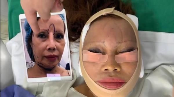 Cô dâu 62 tuổi tự tin livestream với gương mặt sưng phù hậu thẩm mỹ