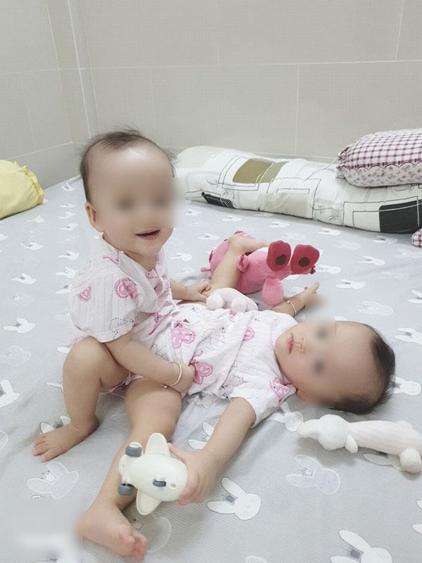 2 em bé song sinh đã được tách dính hoàn toàn, chuyển 2 phòng mổ