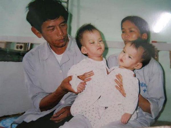 cap song sinh dinh lien noi tieng cuc-an thay doi bat ngo sau 17 nam phau thuat tach roi - 1