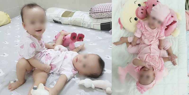 Cặp song sinh đang chờ ngày được tách dính.