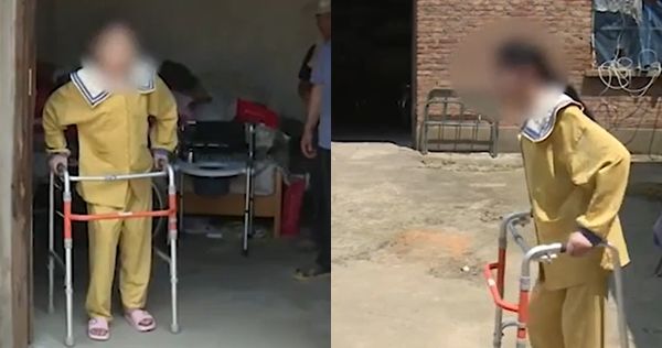 Cuộc sống hậu phẫu của cô gái bị gập đôi người, người chạm đùi trong suốt 10 năm - Ảnh 3