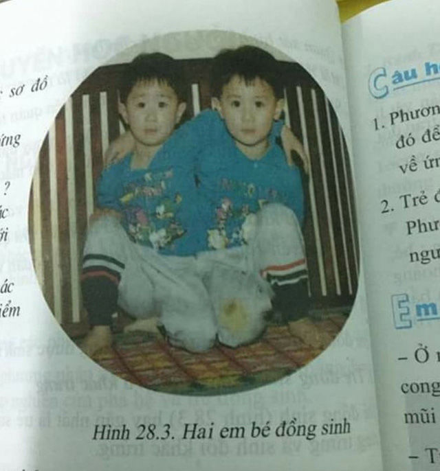 Hình ảnh minh họa cặp song sinh cho bài Di truyền học ở người, phần Sinh đôi cùng trứng.