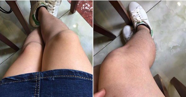 Chùm ảnh: Còn gì khổ hơn những cô nàng phận là con gái nhưng lông mọc còn rậm hơn con trai - Thời Báo