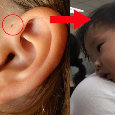 Lỗ rò luân nhĩ – khiếm khuyết bẩm sinh rất nguy hiểm của trẻ mà nhiều cha mẹ lại chủ quan