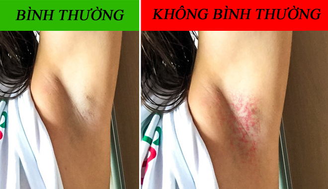 6 dấu hiệu bất thường ở vùng nách cảnh báo sức khỏe có vấn đề, kiểm tra xem có nhiễm độc không 6 dấu hiệu bất thường ở vùng nách cảnh báo sức khỏe có vấn đề, kiểm tra xem có nhiễm độc không